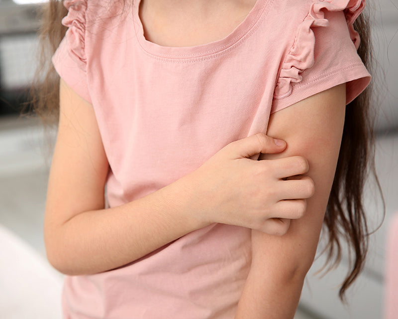 Caring for a Child with Eczema: Tips from Dr. Sylma